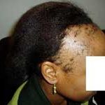 Traction Alopecia - small