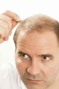 How To Stop Hair Loss - male