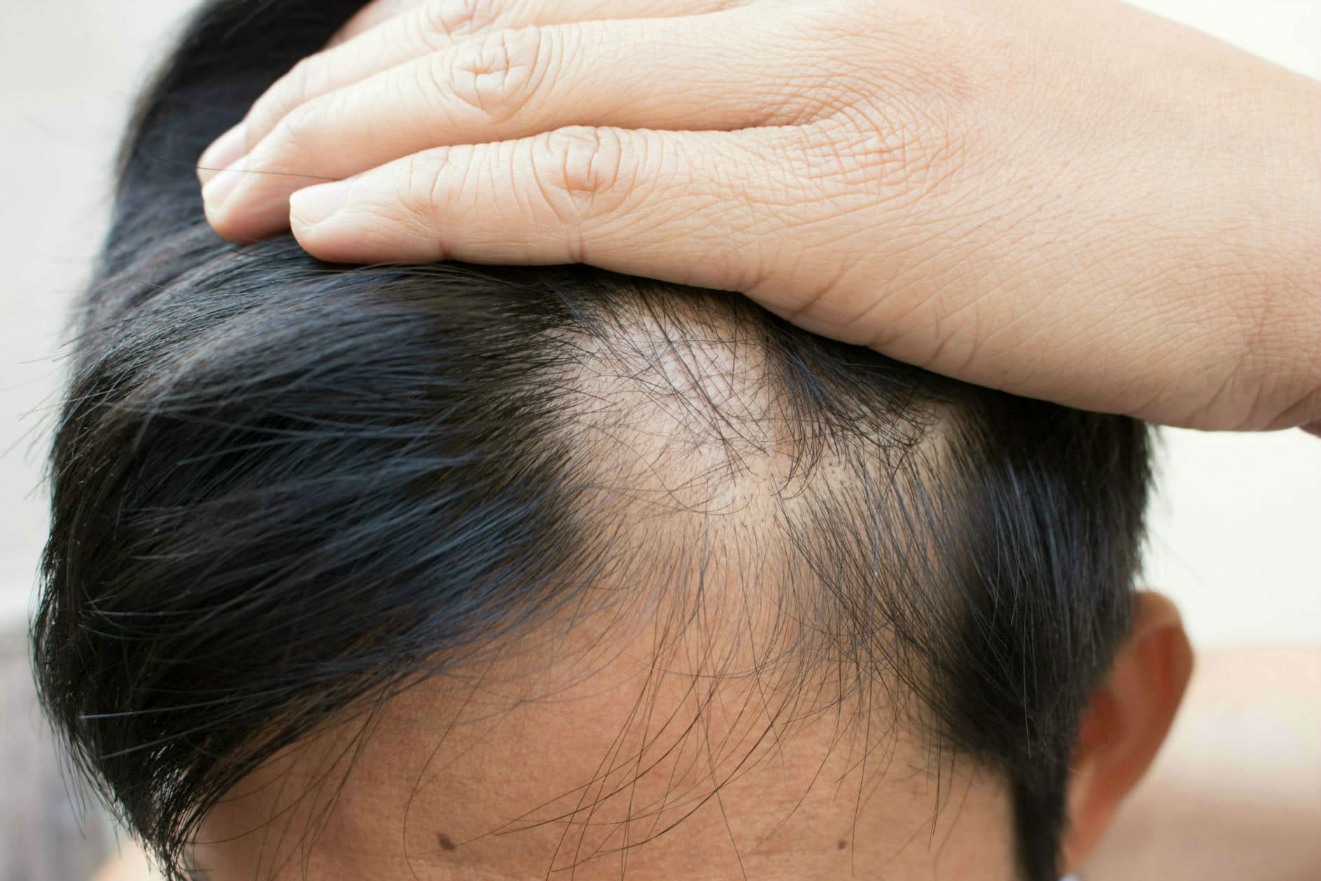 How to Fix Bald Spots