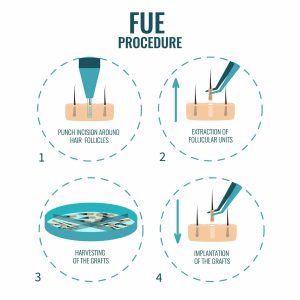 FUE Versus FUT Hair Transplants