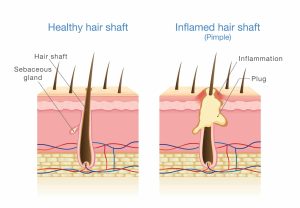 Inflamed Hair Shaft