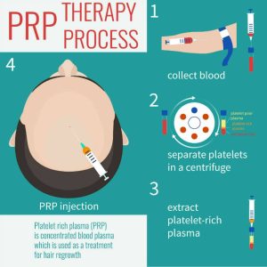 PRP Injection Treatment - Uses And Benefits