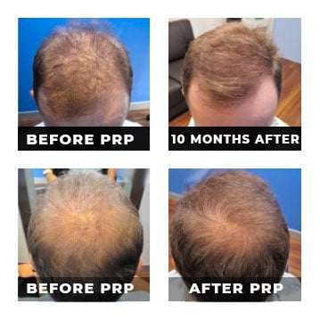Before-&-After-PRP-Treatment-For-Hair-Loss-&-Rejuvenation