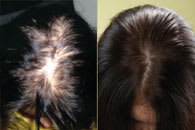 Female Laser Hair Growth Treatment before and after