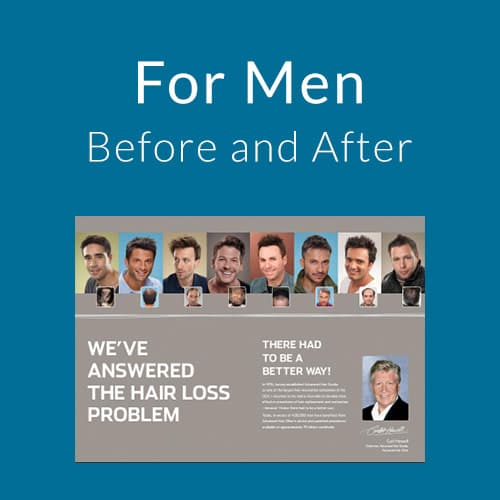 For Men Hair Loss Before After