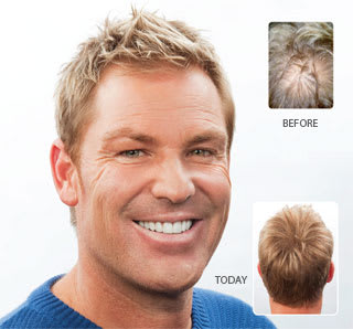 Shane Warne Hair Loss Treatment Results